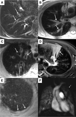 Contrast agent-free functional magnetic resonance imaging with matrix pencil decomposition to quantify abnormalities in lung perfusion and ventilation in patients with cystic fibrosis